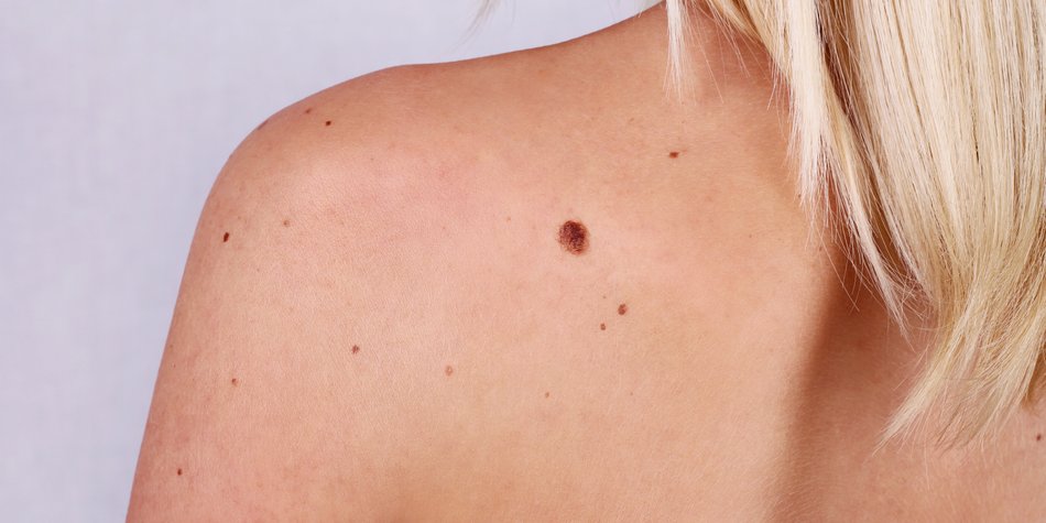 Mit dem ABCDE-Trick kannst du Hautkrebs selbst erkennen Mit dem ABCDE-Trick kannst du Hautkrebs selbst erkennen