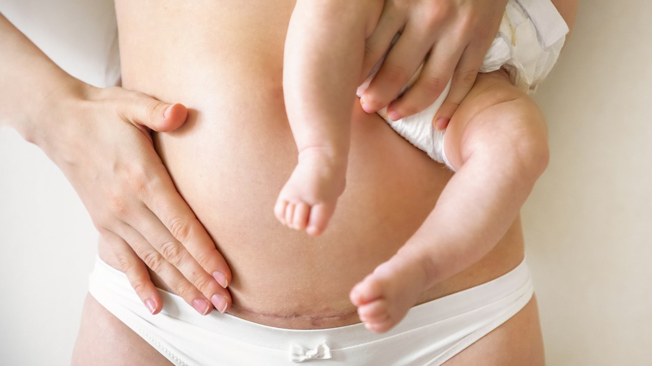 Closeup of woman belly with a scar from a cesarean section. Woman with baby on her hand