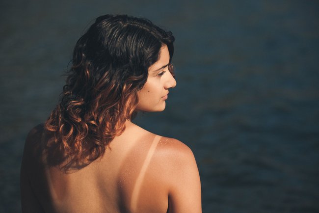 A beautiful young woman at the beach showing a sunburn with blisters on her bare shoulders A beautiful young woman at the beach showing a sunburn with blisters on her bare shoulders