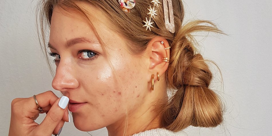Hanna Bohnekamp: „Ich muss meine Pickel nicht lieben!“ Hanna Bohnekamp: „Ich muss meine Pickel nicht lieben!“