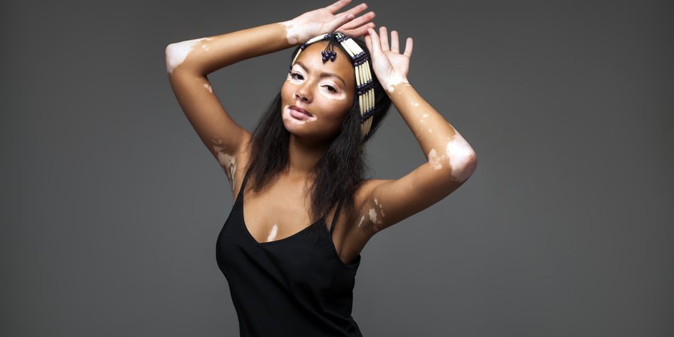 Body Positivity: Vitiligo geht auf Instagram viral Body Positivity: Vitiligo geht auf Instagram viral