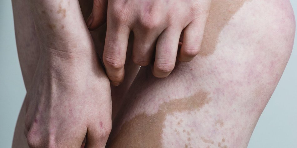 Vitiligo Vitiligo