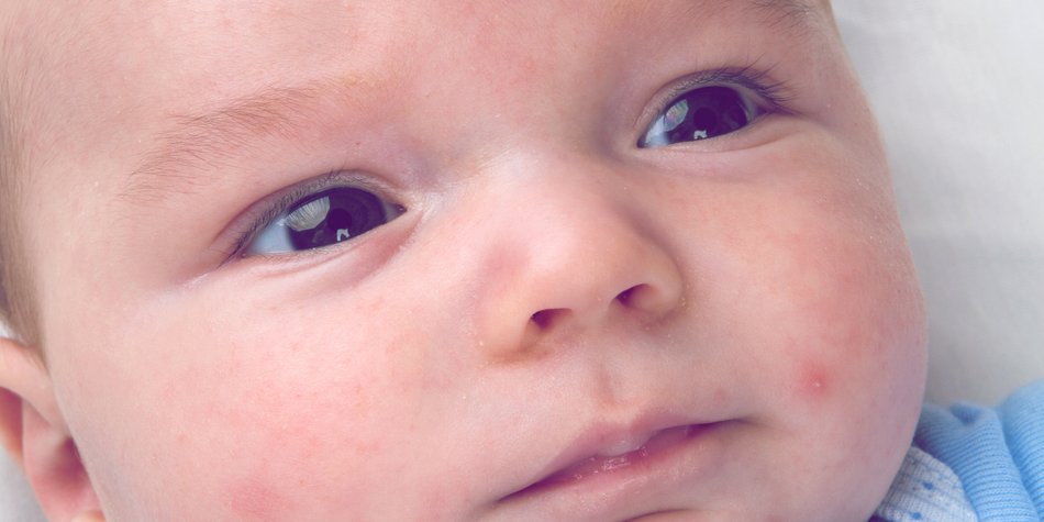 Hitzepickel beim Baby oder Kleinkind: 11 Tipps Hitzepickel beim Baby oder Kleinkind: 11 Tipps