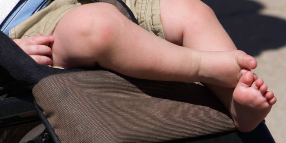 Sonnenbrand beim Baby: 4 Erste-Hilfe-Tipps Sonnenbrand beim Baby: 4 Erste-Hilfe-Tipps