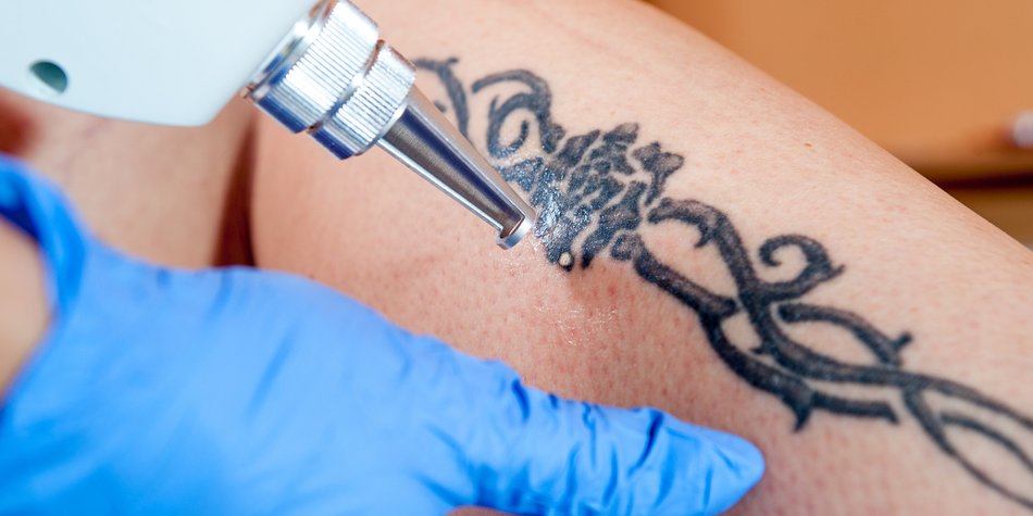 Das solltest du vor der Tattooentfernung wissen Das solltest du vor der Tattooentfernung wissen