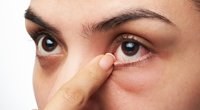 7 Hausmittel gegen trockene Augen, die wirklich helfen