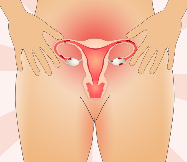 Endometriose Gebärmutter