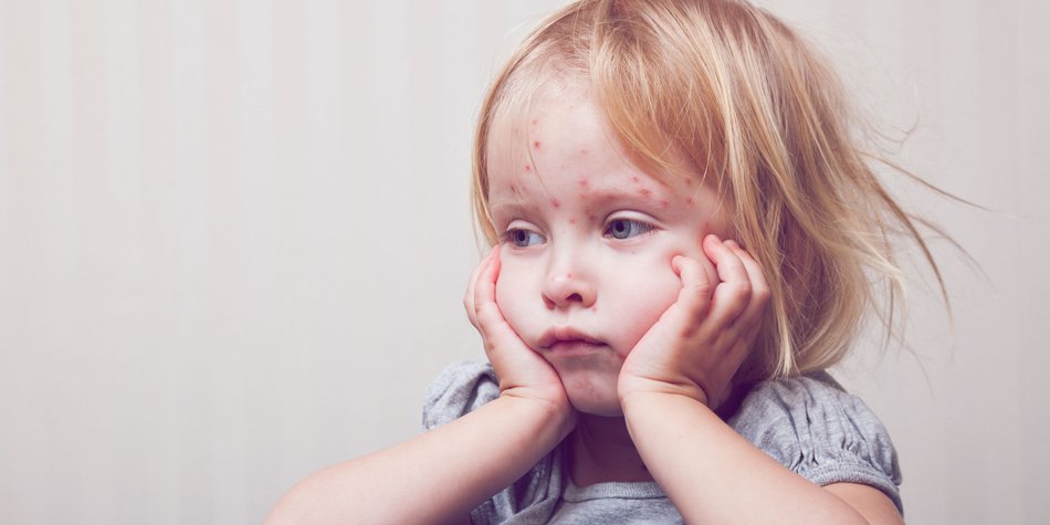 Masern beim Kind: Ursachen, Symptome & schnelle Hilfe Masern beim Kind: Ursachen, Symptome & schnelle Hilfe