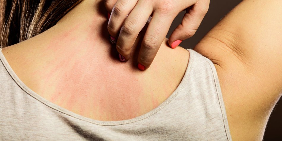 Sonnenallergie: Hausmittel gegen den Ausschlag Sonnenallergie: Hausmittel gegen den Ausschlag
