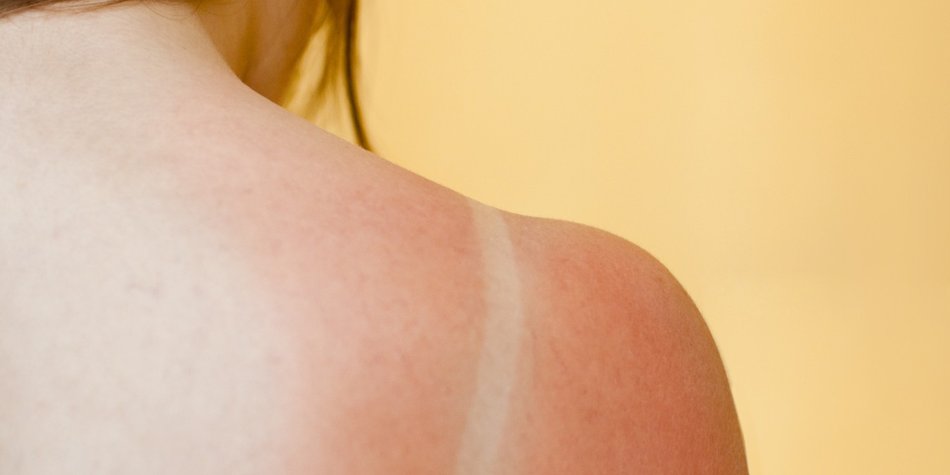 Sonnenbrand: Erste Hilfe gegen rote Haut Sonnenbrand: Erste Hilfe gegen rote Haut