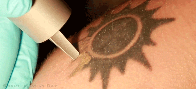 Laserentfernung Tattoo