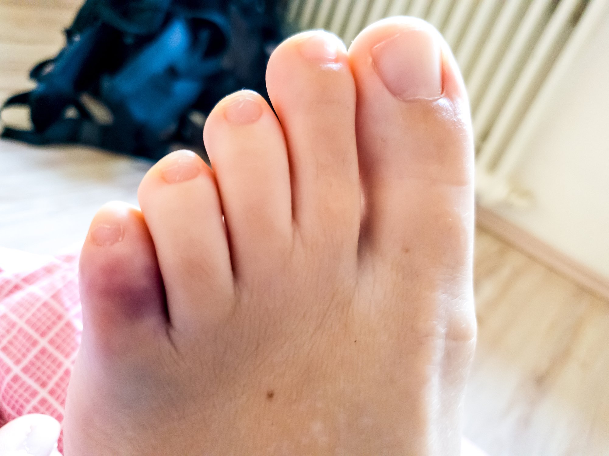 фото ушибленного пальца на ноге