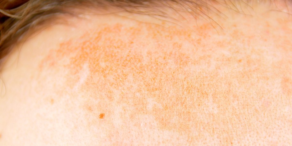Chloasma: Darum entstehen die dunklen Pigmentflecken Chloasma: Darum entstehen die dunklen Pigmentflecken