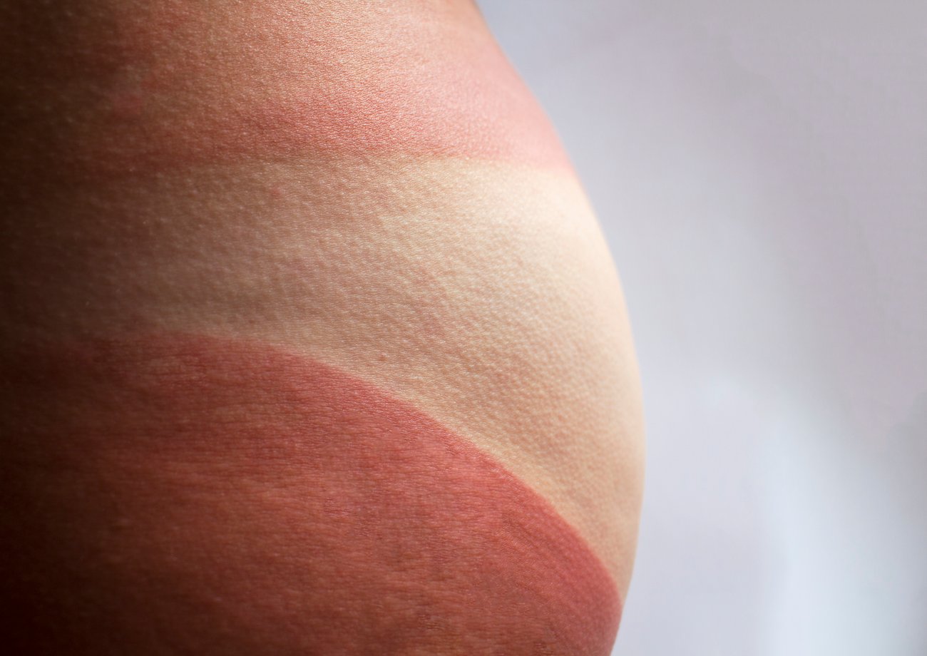Sonnenbrand auf dem Po Sonnenbrand auf dem Po