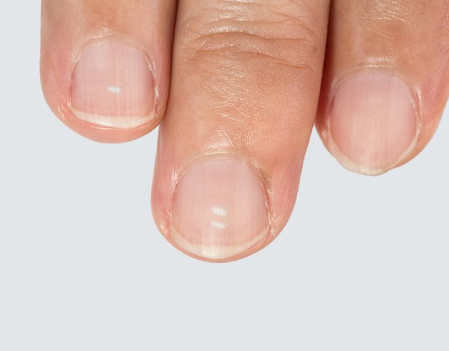 Fingernägel weiße Flecken Ursachen