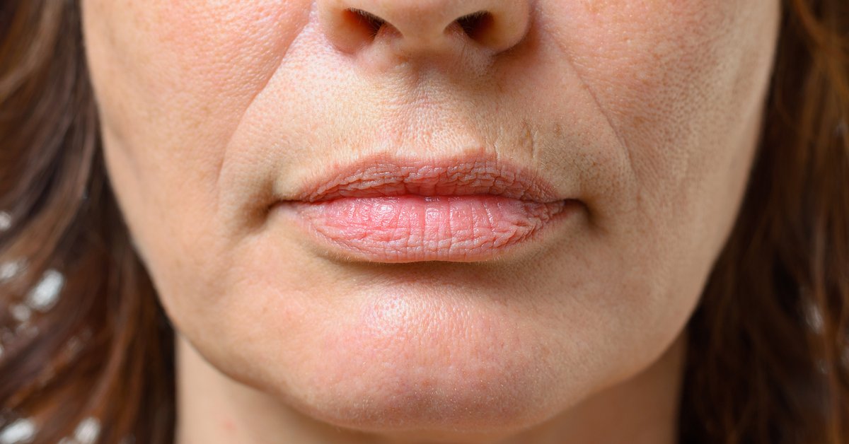 Lippenfalten Entfernen Mit Diesen 3 Methoden Desired De