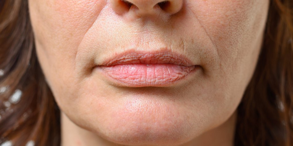 Lippenfalten entfernen: Mit diesen Methoden