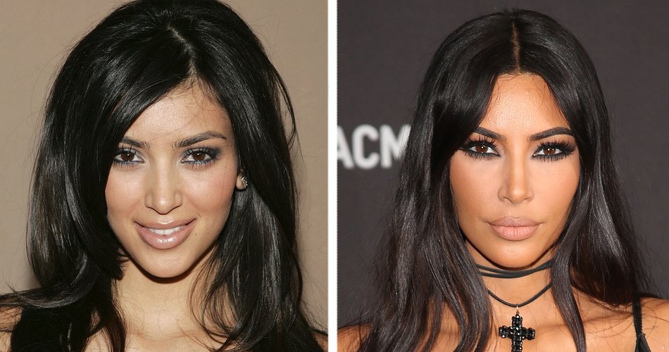 Stars Mit Botox Botox-Sucht? Stars vor und nach ihren Beauty-OPs