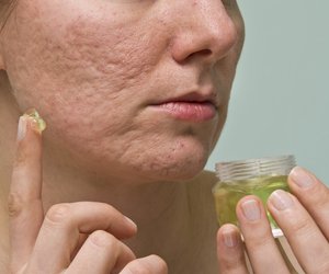 Aknenarben entfernen: Mit diesen Tipps klappt's