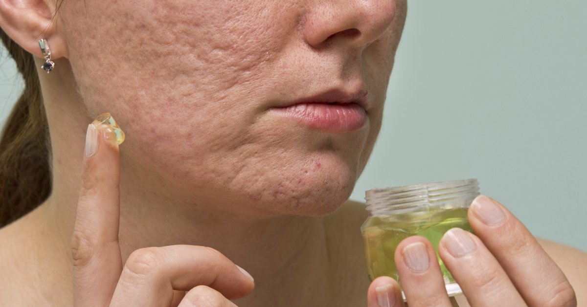 Aknenarben Entfernen Die Besten Tipps Fur Narbenfreie Haut Desired De