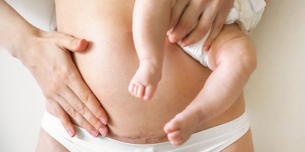 Kaiserschnitt-Geburt: Wann ist sie nötig & welche Folgen hat sie?