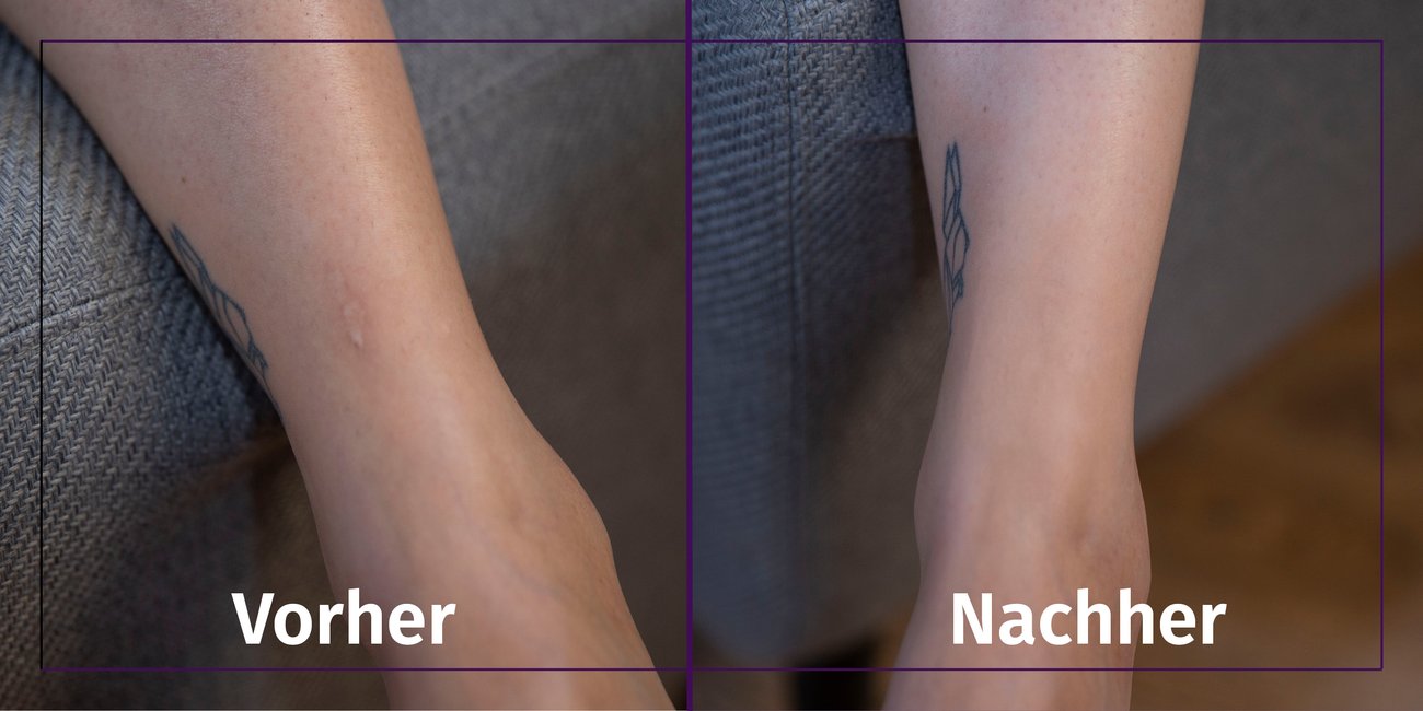 Narben abdecken Narben abdecken