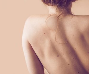 Muttermal aufgekratzt? Das musst du jetzt beachten