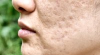 Akne-Behandlung: 7 Möglichkeiten, Akne zu bekämpfen