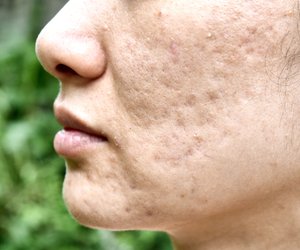 Akne-Behandlung: 7 Möglichkeiten, Akne zu bekämpfen