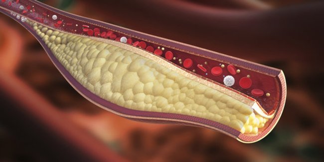 Nephrotisches Syndrom: eine Thrombose Nephrotisches Syndrom: eine Thrombose