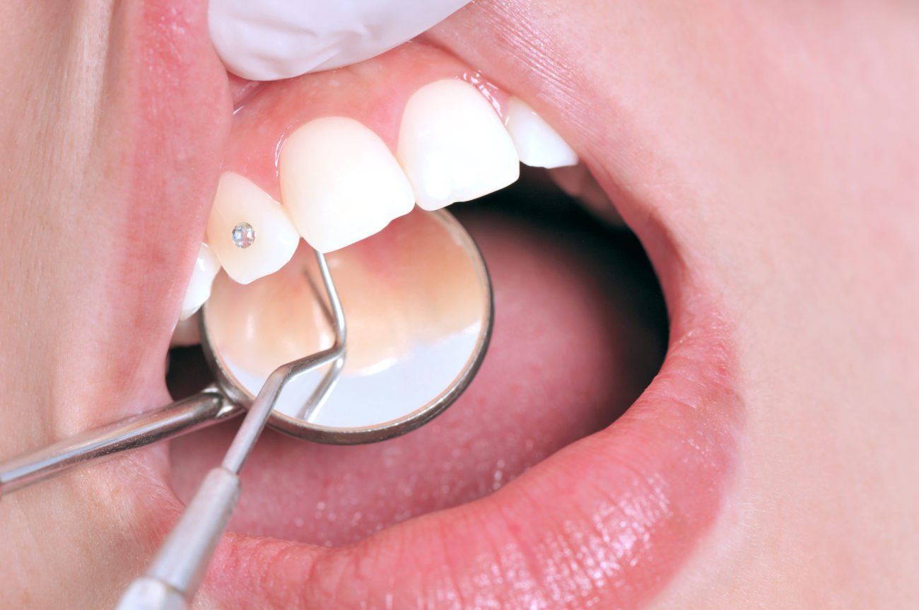 Zahnschmuck sollte vom Zahnarzt angebracht und entfernt werden.