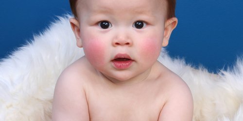Rote Wangen beim Baby: Warum hat mein Baby rote Wangen?