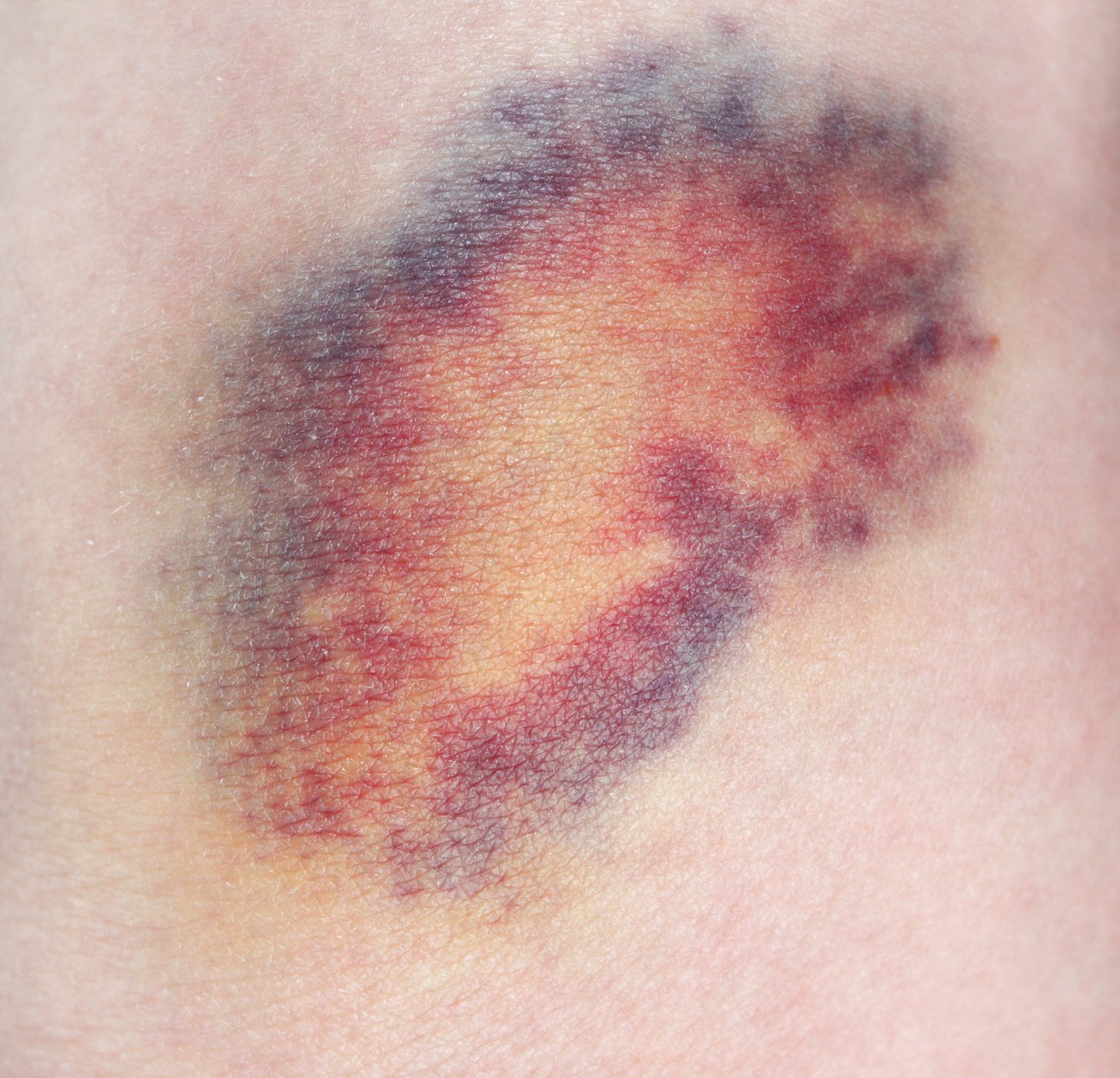 Blaue Flecken Blaue Flecken