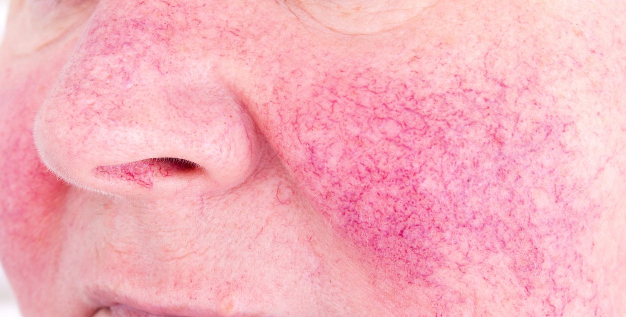 Rosacea behandeln Rosacea behandeln