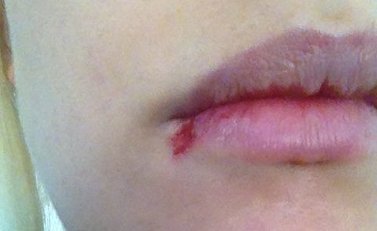 Herpes vom Stress scheint eine Nebenwirkung zu sein. Herpes vom Stress scheint eine Nebenwirkung zu sein.