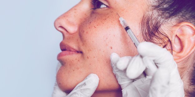 Baby Botox: Meine ehrlichen Erfahrungen mit dem Beauty-Trend