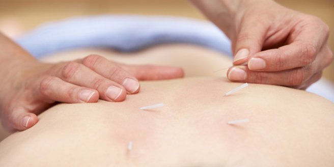 Akupunktur und Schwangerschaft: Eine Akupunkturbehandlung.