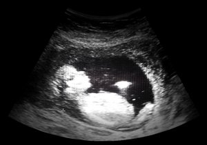 Baby in der 38. SSW Baby in der 38. SSW
