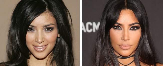 Botox-Sucht: Die Stars vor und nach ihren Beauty-OPs
