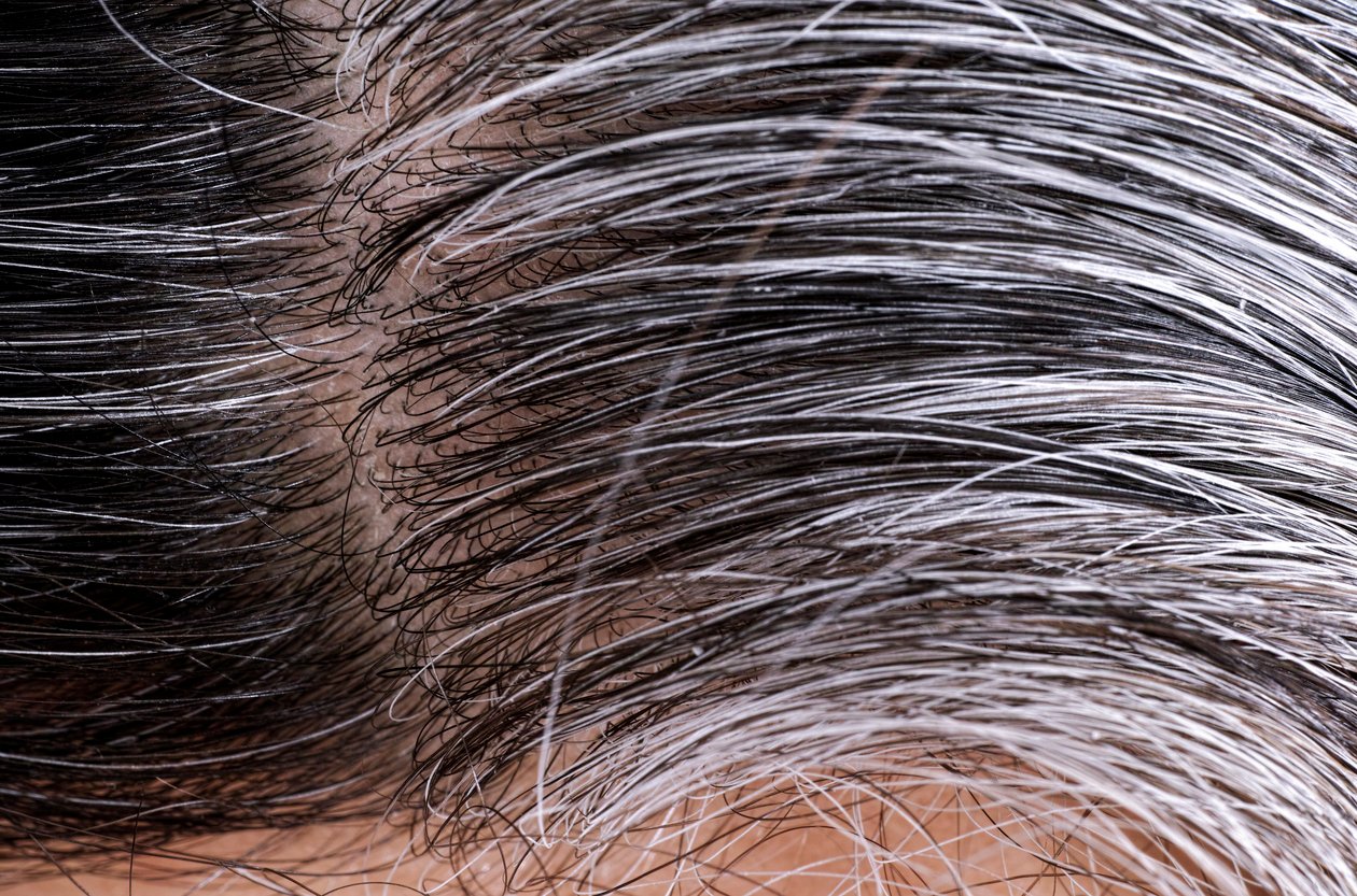 Warum werden Haare grau Ursachen
