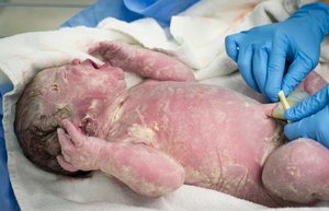 Käseschmiere beim Baby Käseschmiere beim Baby