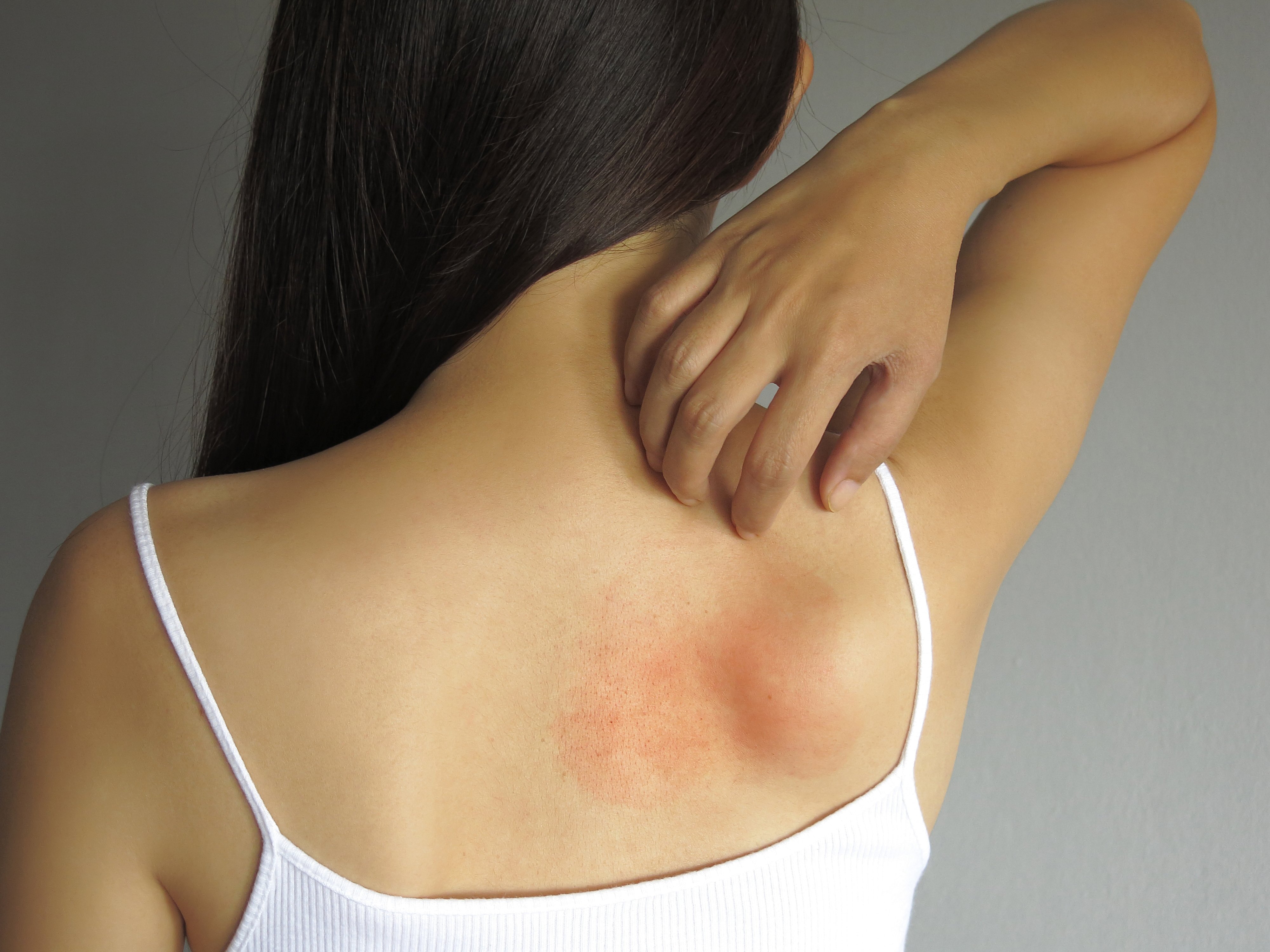 Allergisch bedingter Hautausschlag Allergisch bedingter Hautausschlag