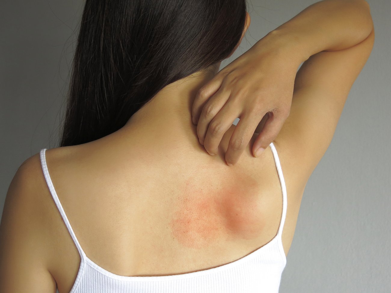 Allergisch bedingter Hautausschlag