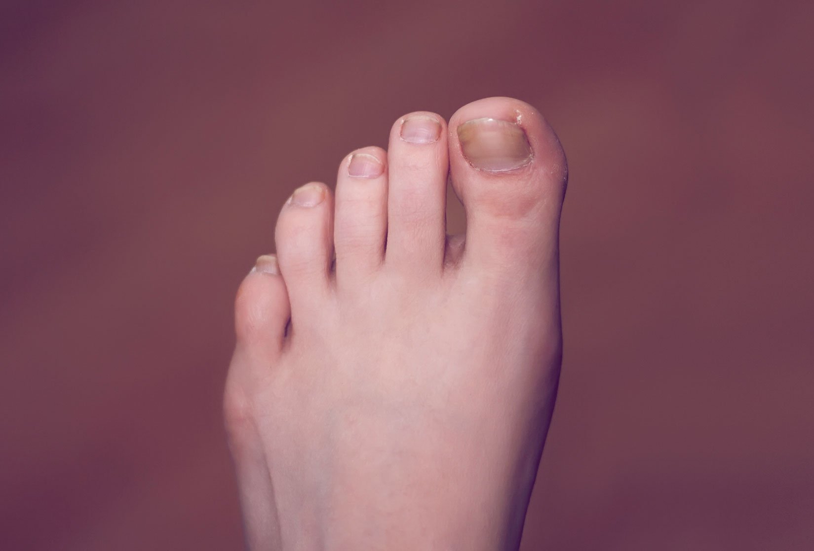 verfärbte Fußnägel