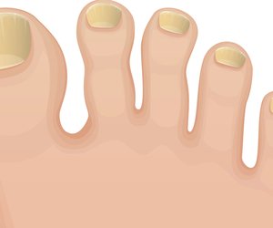 Gelbe Fußnägel: Ursachen & Hausmittel