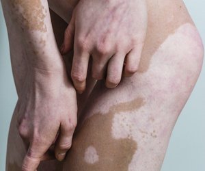 Vitiligo - weiße Flecken auf der Haut