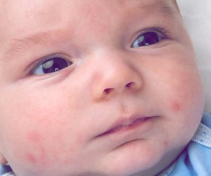 Hitzepickel beim Baby oder Kleinkind: 11 Tipps