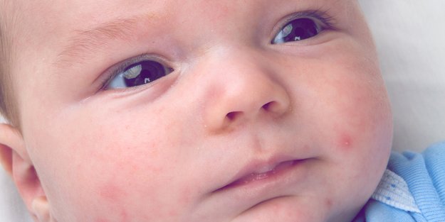 Hitzepickel beim Baby oder Kleinkind: 10 Tipps