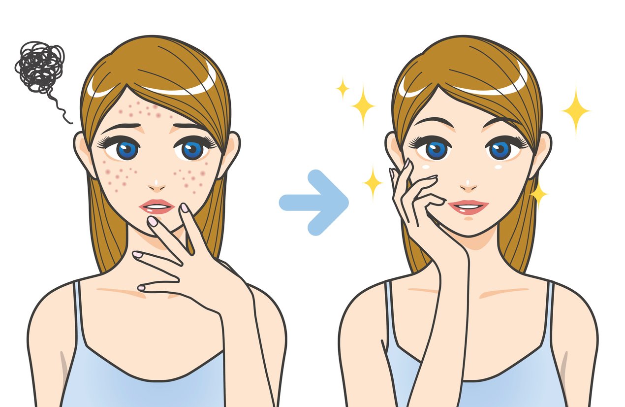Tipps gegen kleine Pickel im Gesicht
