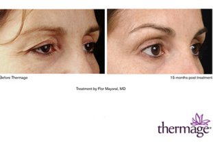 Erfolge mit Thermage Erfolge mit Thermage